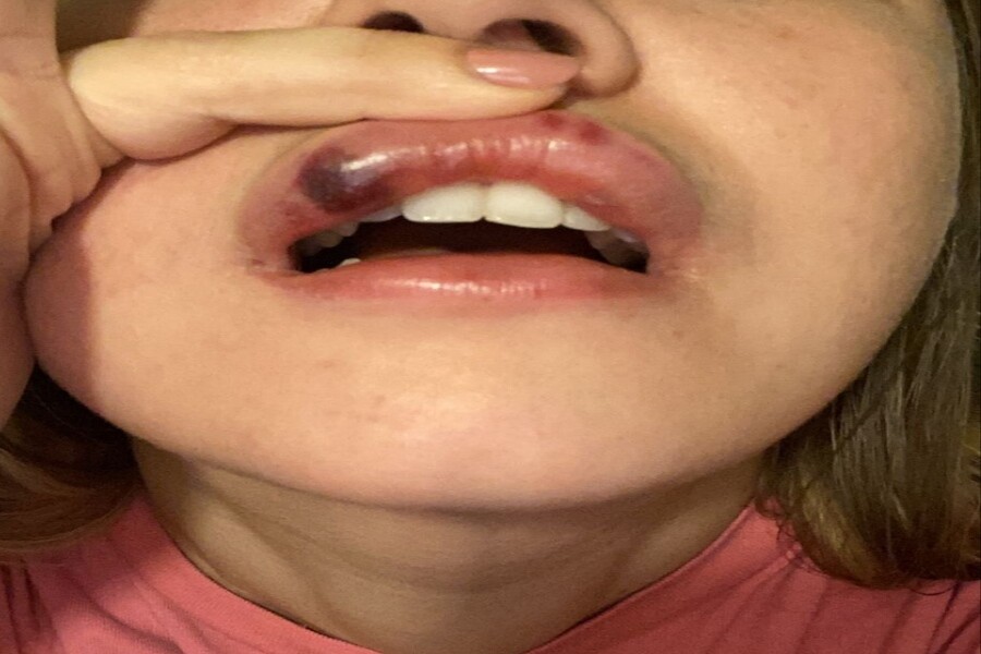 تصویری از لب نکروز شده